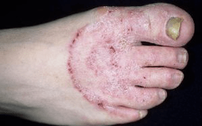 Le ragioni dell'apparizione del fungo sulle gambe