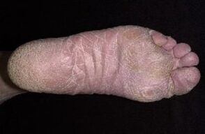 Segni e sintomi di funghi sulle gambe