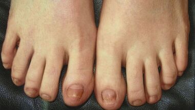 Fasi di sviluppo del fungo delle unghie