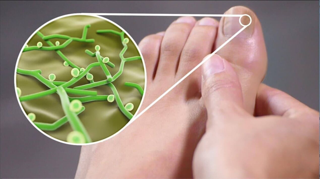 Agente patogeno del fungo dell'unghia del piede