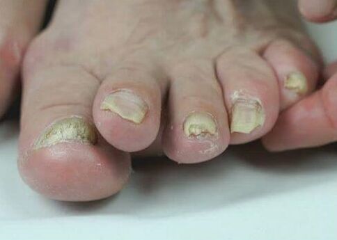 Trattare i funghi delle unghie con i farmaci