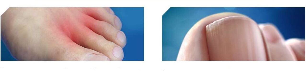 Stadio iniziale del piede d'atleta